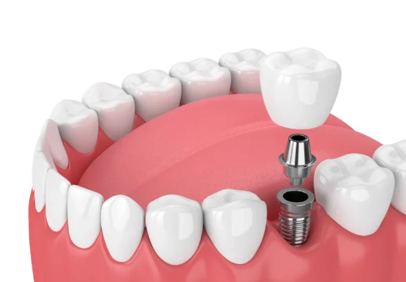 how much is a fake tooth
